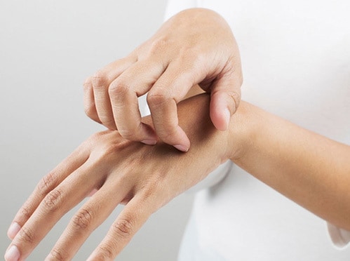 Dry skin on hands - Use Dermeze produdts for dry and sensitive skin