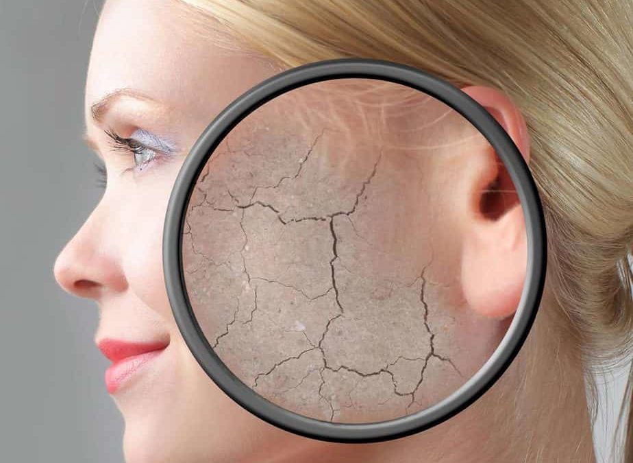 Dry Skin Explained – Causes, Prevention and Treatment